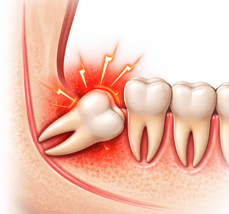 Chirurgia Denti del Giudizio