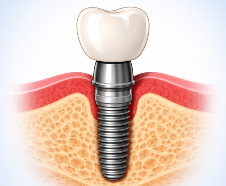 Chirurgia Implantare